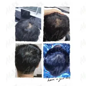 รีวิวก่อนใช้-หลังใช้ ผลิตภัณฑ์ AloEx