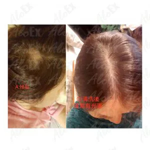 รีวิวก่อนใช้-หลังใช้ ผลิตภัณฑ์ AloEx