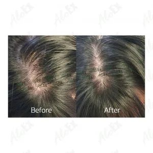 รีวิวก่อนใช้-หลังใช้ ผลิตภัณฑ์ AloEx