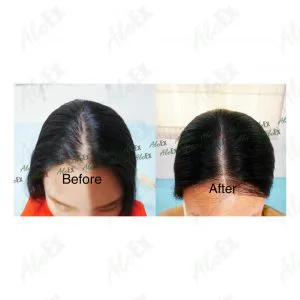 รีวิวก่อนใช้-หลังใช้ ผลิตภัณฑ์ AloEx