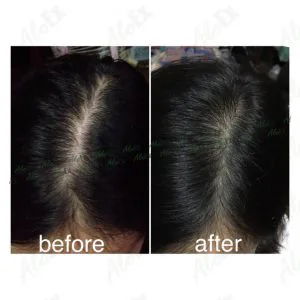 รีวิวก่อนใช้-หลังใช้ ผลิตภัณฑ์ AloEx