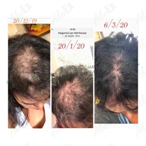 รีวิวก่อนใช้-หลังใช้ ผลิตภัณฑ์ AloEx