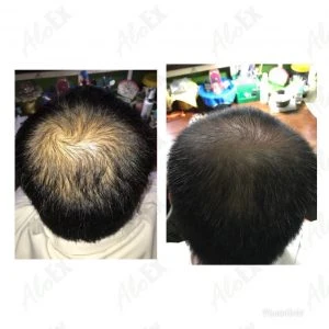 รีวิวก่อนใช้-หลังใช้ ผลิตภัณฑ์ AloEx