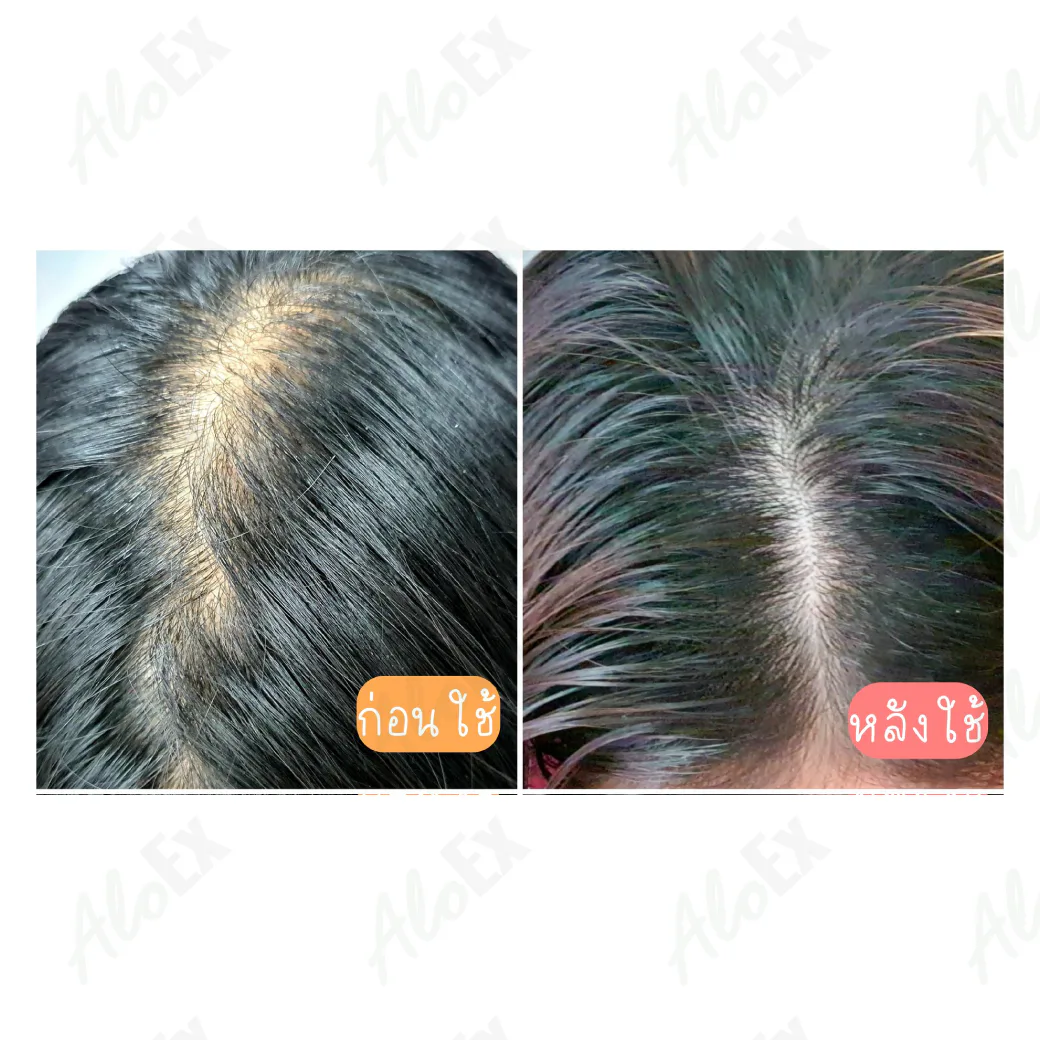 รีวิวก่อนใช้-หลังใช้ ผลิตภัณฑ์ AloEx
