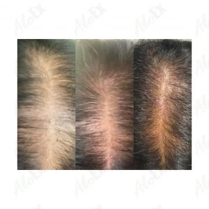 รีวิวก่อนใช้-หลังใช้ ผลิตภัณฑ์ AloEx