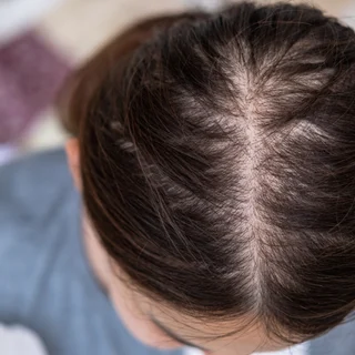 Hereditary hair loss and thinning
