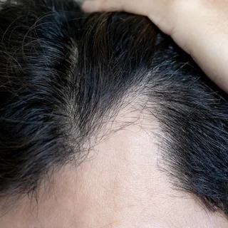 An M-shaped receding hairline