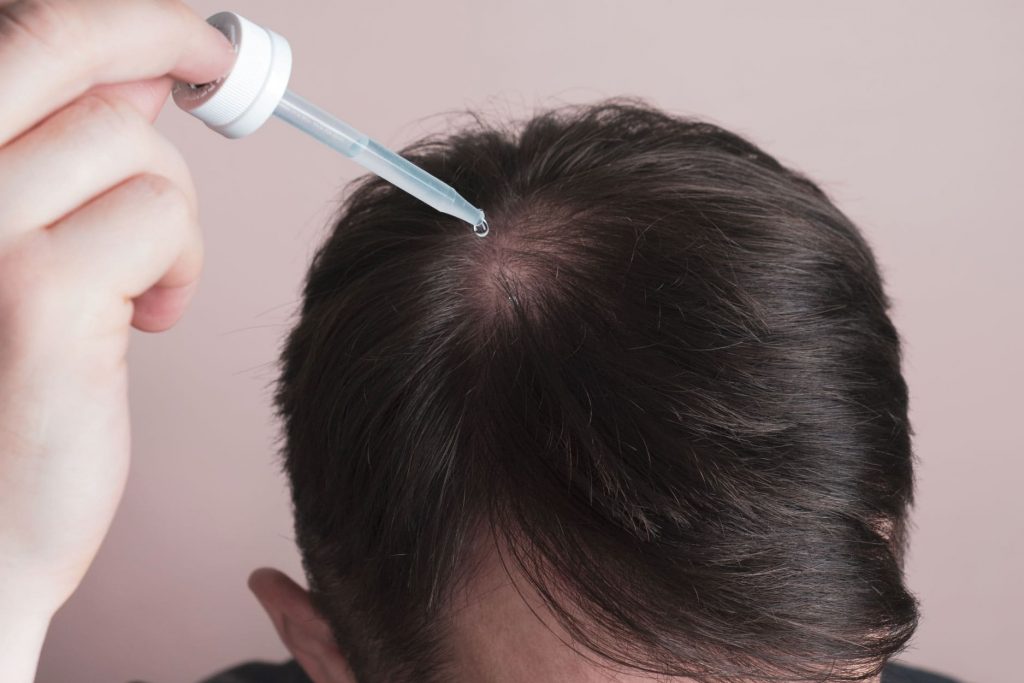 Minoxidil แบบทา