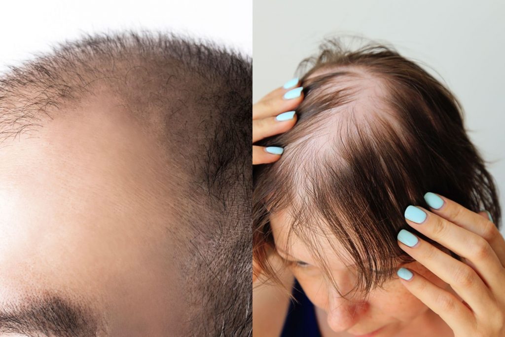 ผมร่วงใช้ Minoxidil